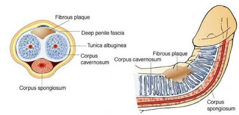 Peyronie’s Disease