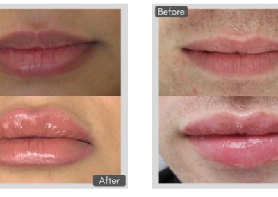 Lip injections before and after