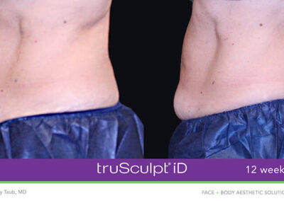 TruSculpt Body Sculpting in Ottawa Before and After