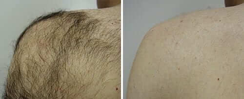 Laser Hair Removal for Shoulders in Ottawa