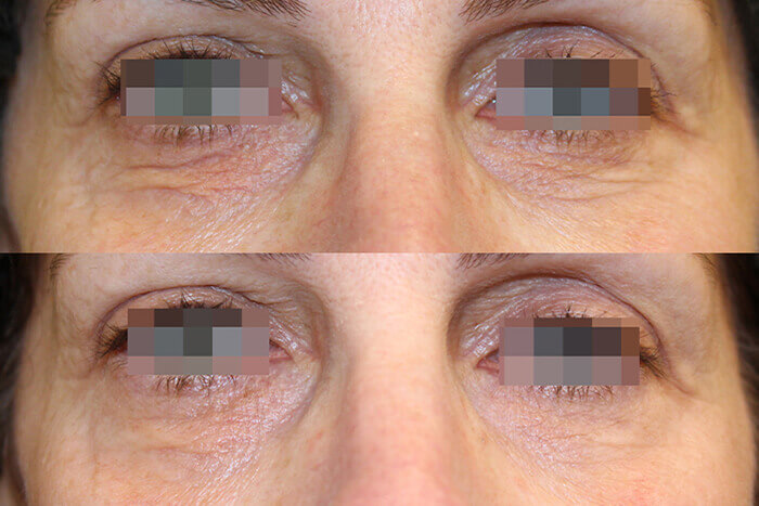 Droopy Eye Treatment in Ottawa