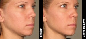 Ultherapy before and after