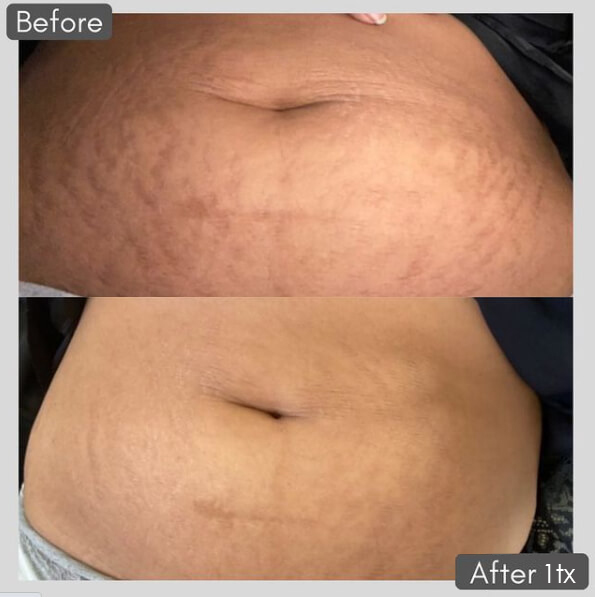 Stretch Marks Treatments, Reno, NV