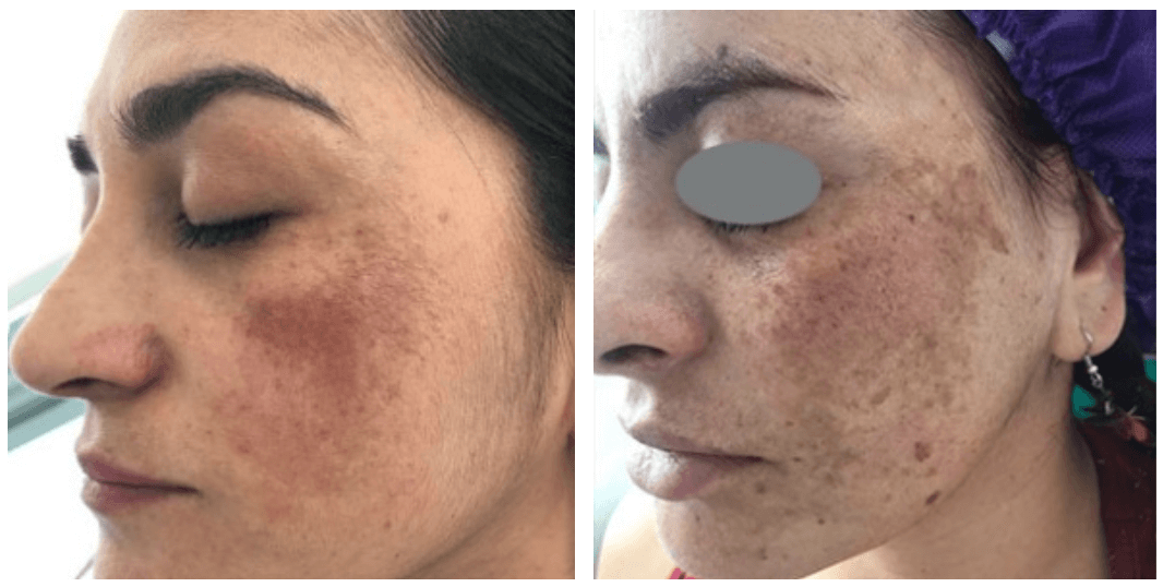 The Difference Between Melasma and Other Skin Spots