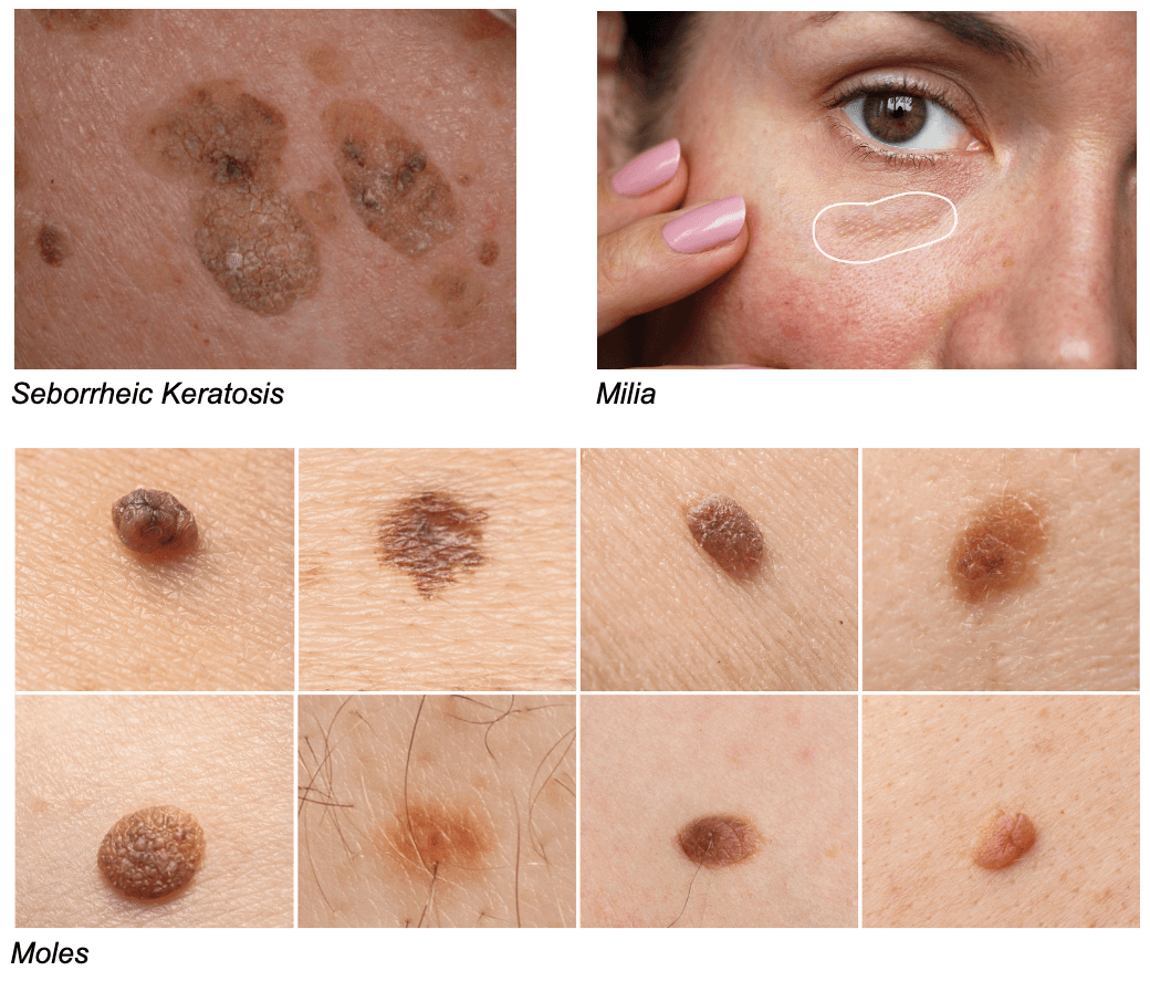 Melasma Moles Pigmentation Inovo Medical Aesthetics