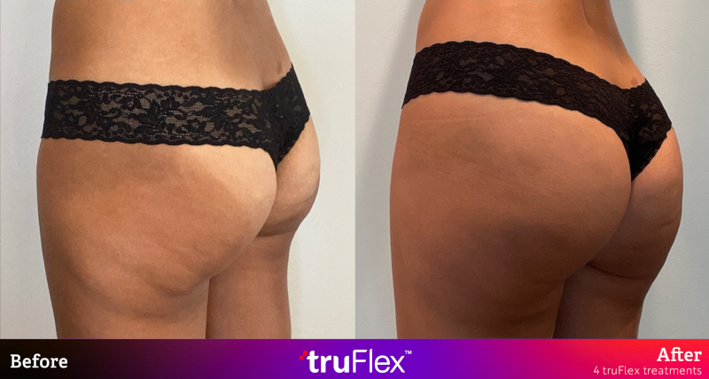 Sculptra BBL Non Surgical Butt Lift Before and After Pictures