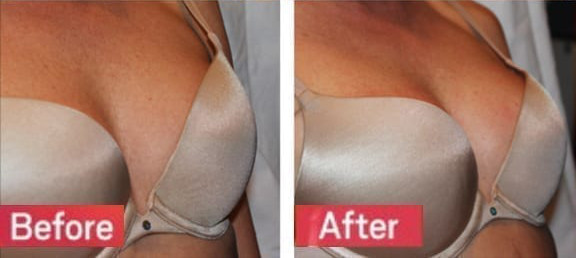 Regenerative Breast Lift